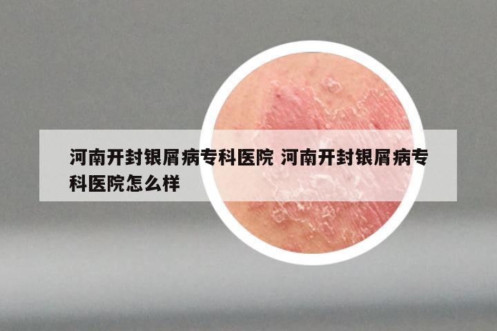 河南开封银屑病专科医院 河南开封银屑病专科医院怎么样