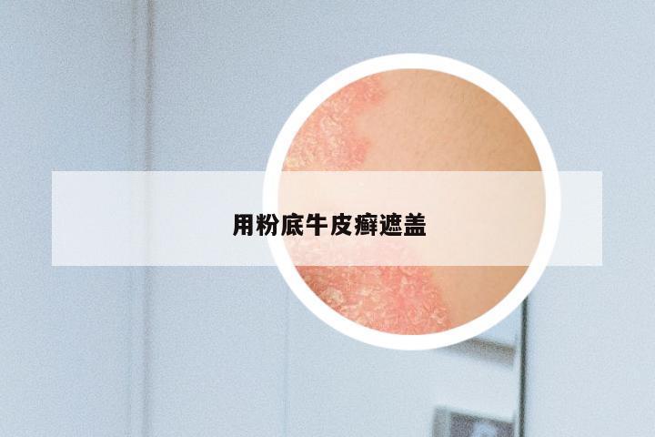 用粉底牛皮癣遮盖