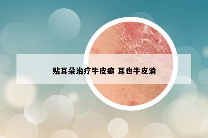 贴耳朵治疗牛皮癣 耳也牛皮消