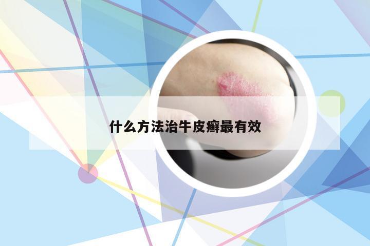 什么方法治牛皮癣最有效