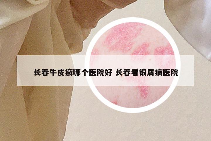 长春牛皮癣哪个医院好 长春看银屑病医院