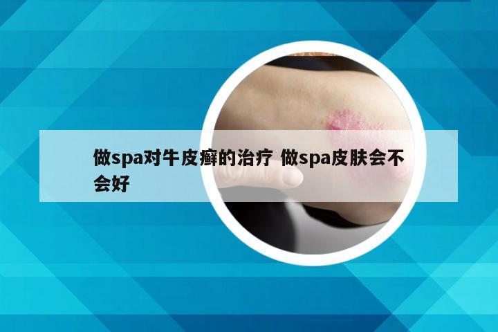 做spa对牛皮癣的治疗 做spa皮肤会不会好