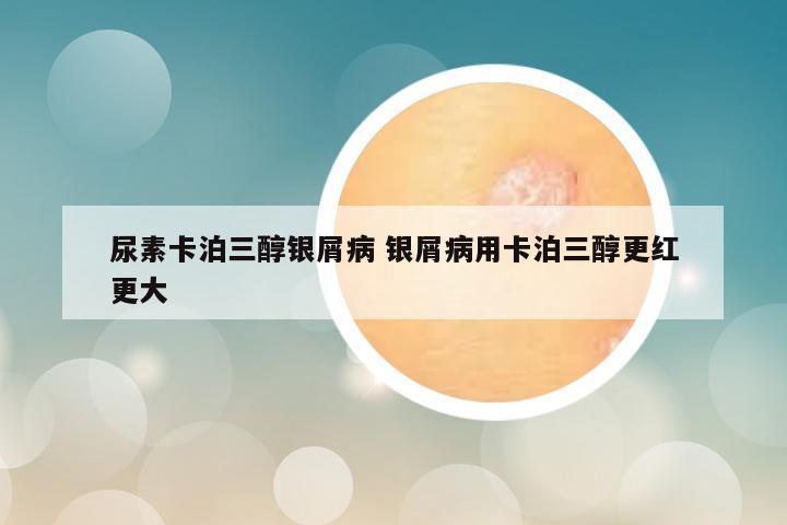 尿素卡泊三醇银屑病 银屑病用卡泊三醇更红更大