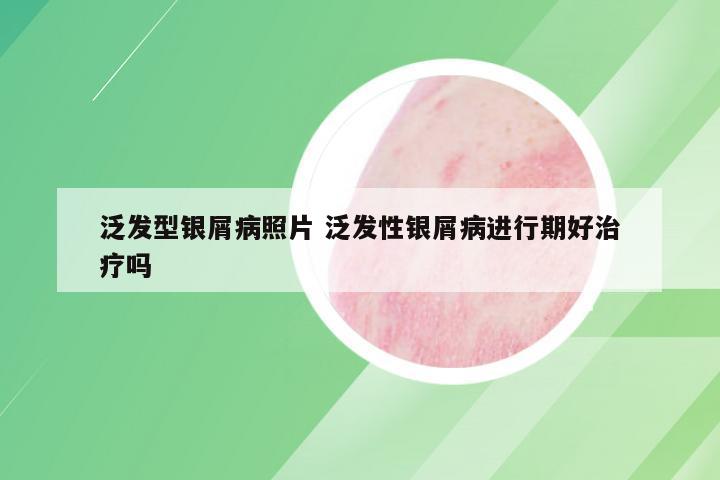 泛发型银屑病照片 泛发性银屑病进行期好治疗吗
