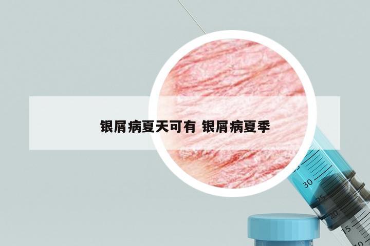 银屑病夏天可有 银屑病夏季
