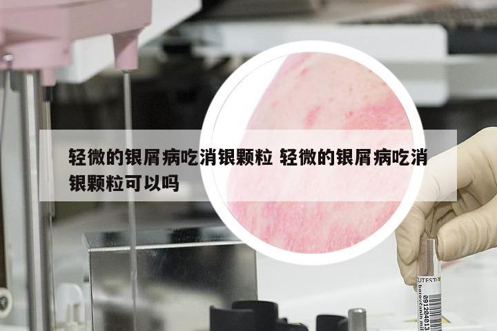 轻微的银屑病吃消银颗粒 轻微的银屑病吃消银颗粒可以吗