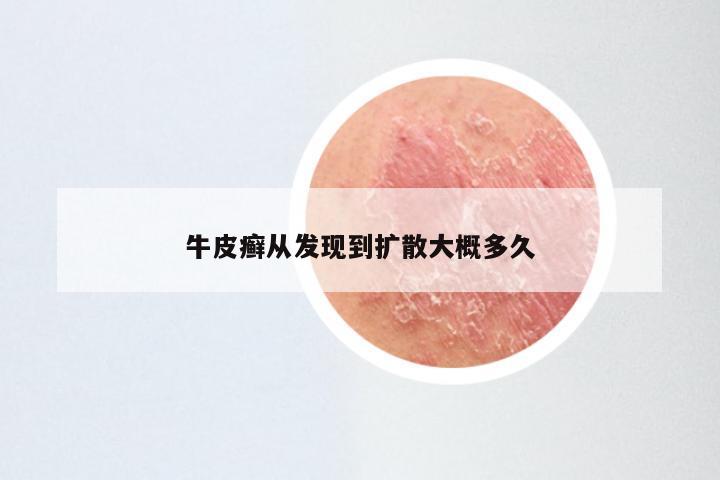 牛皮癣从发现到扩散大概多久