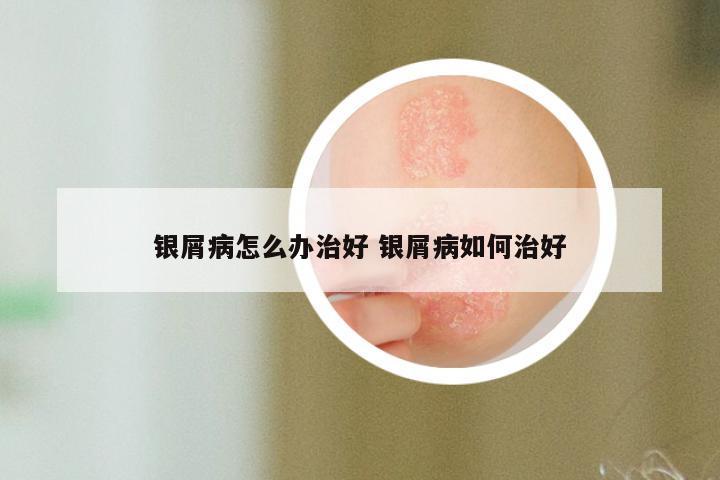 银屑病怎么办治好 银屑病如何治好