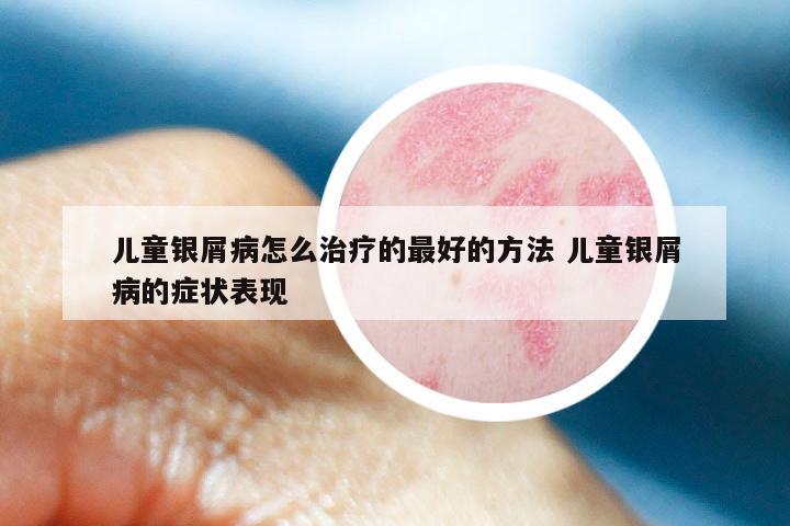 儿童银屑病怎么治疗的最好的方法 儿童银屑病的症状表现