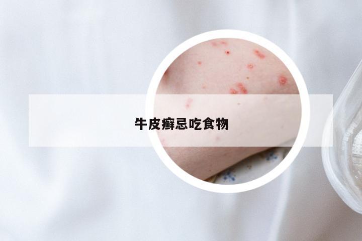 牛皮癣忌吃食物