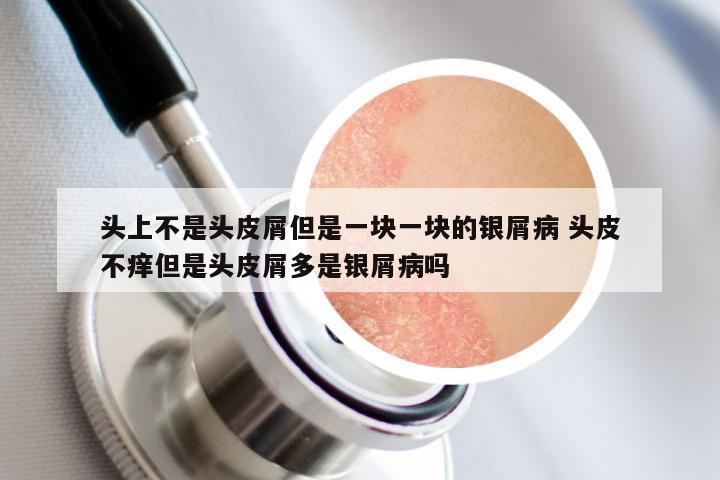 头上不是头皮屑但是一块一块的银屑病 头皮不痒但是头皮屑多是银屑病吗