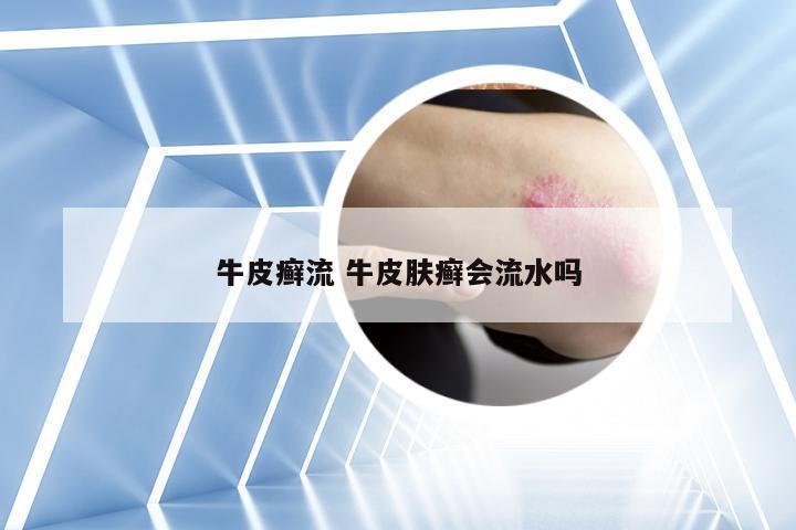 牛皮癣流 牛皮肤癣会流水吗