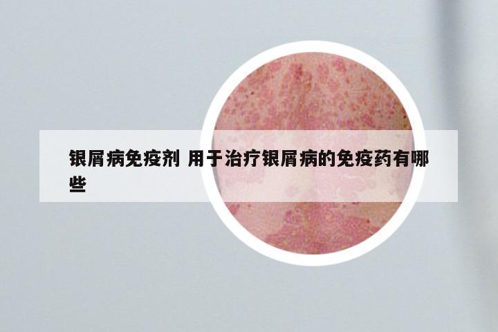 银屑病免疫剂 用于治疗银屑病的免疫药有哪些