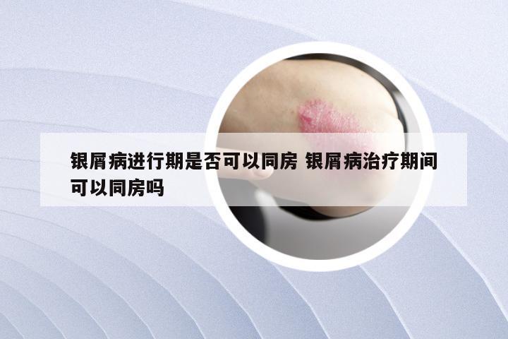 银屑病进行期是否可以同房 银屑病治疗期间可以同房吗
