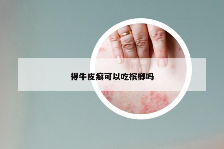 得牛皮癣可以吃槟榔吗
