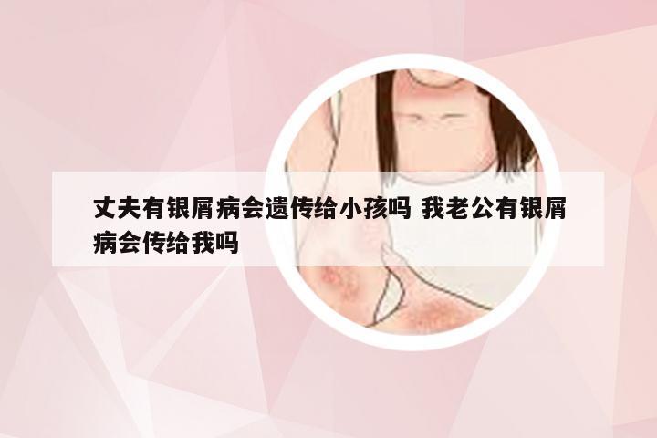 丈夫有银屑病会遗传给小孩吗 我老公有银屑病会传给我吗