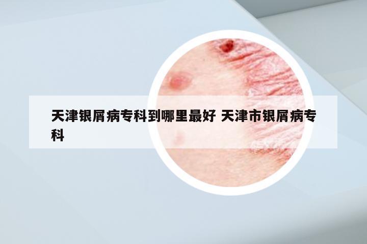 天津银屑病专科到哪里最好 天津市银屑病专科