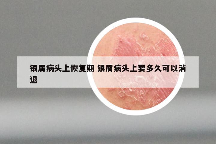 银屑病头上恢复期 银屑病头上要多久可以消退