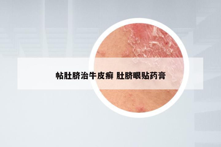 帖肚脐治牛皮癣 肚脐眼贴药膏