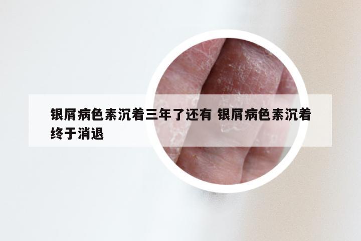 银屑病色素沉着三年了还有 银屑病色素沉着终于消退