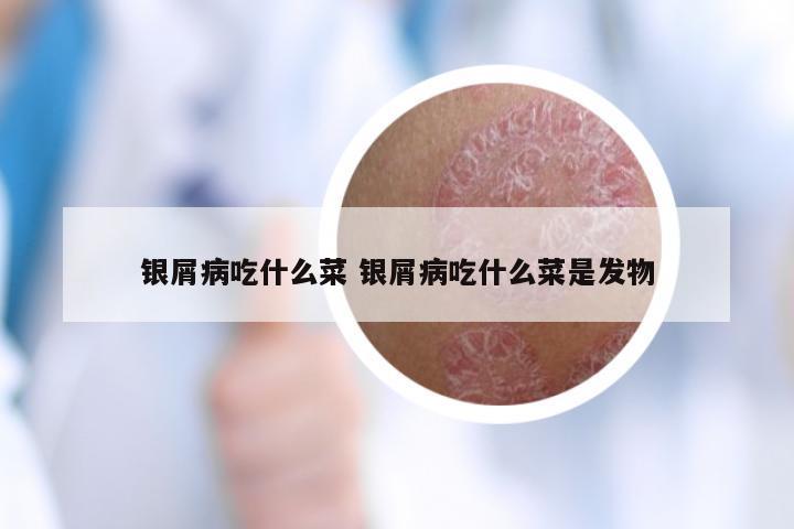 银屑病吃什么菜 银屑病吃什么菜是发物