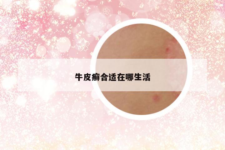 牛皮癣合适在哪生活