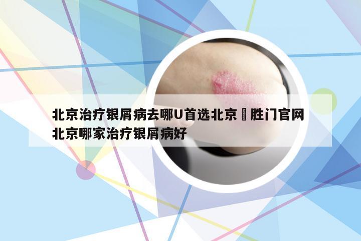 北京治疗银屑病去哪U首选北京徳胜门官网 北京哪家治疗银屑病好