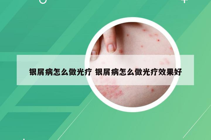 银屑病怎么做光疗 银屑病怎么做光疗效果好