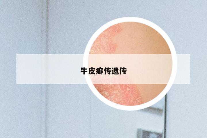 牛皮癣传遗传