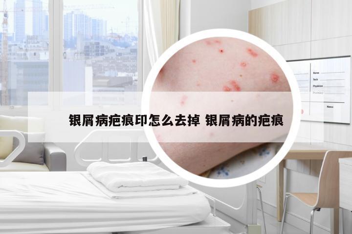 银屑病疤痕印怎么去掉 银屑病的疤痕