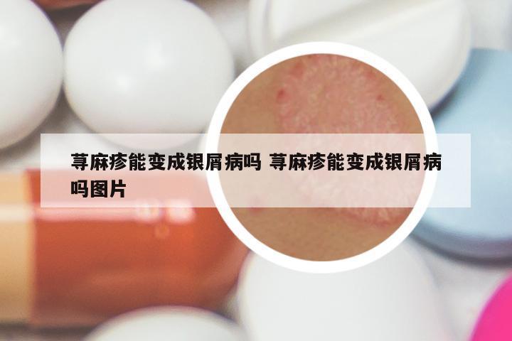 荨麻疹能变成银屑病吗 荨麻疹能变成银屑病吗图片