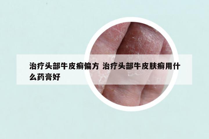治疗头部牛皮癣偏方 治疗头部牛皮肤癣用什么药膏好