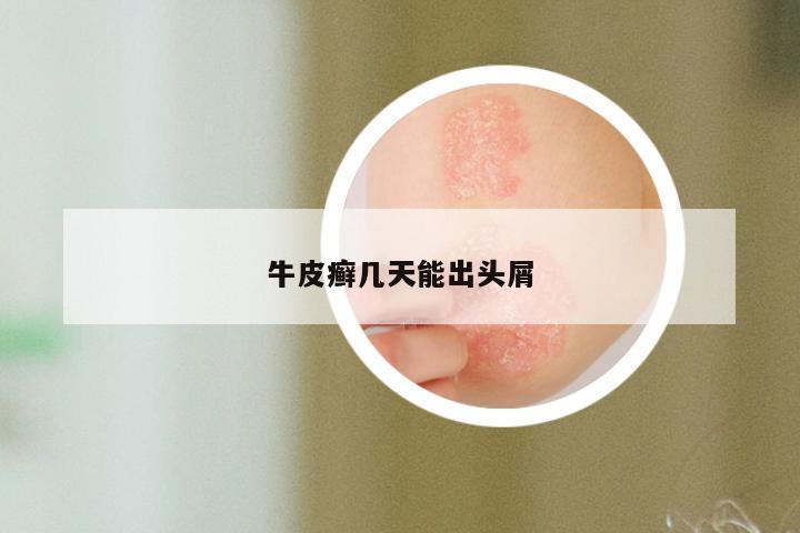 牛皮癣几天能出头屑