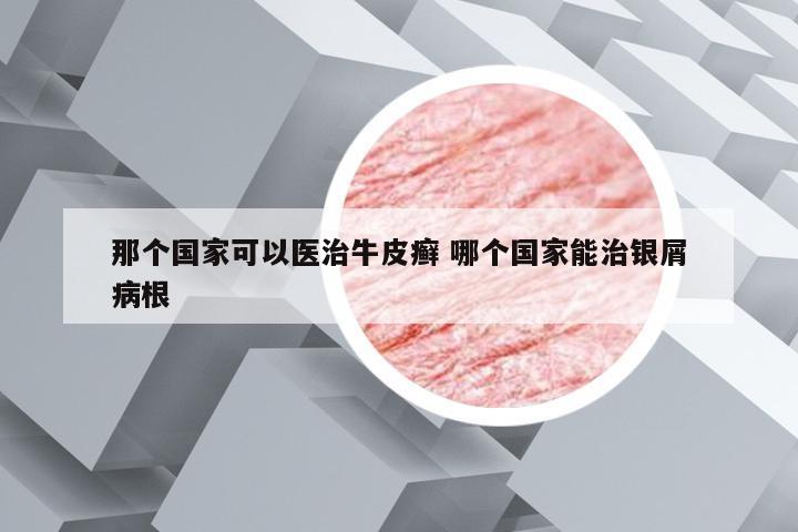 那个国家可以医治牛皮癣 哪个国家能治银屑病根