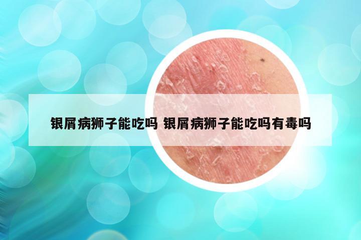 银屑病狮子能吃吗 银屑病狮子能吃吗有毒吗