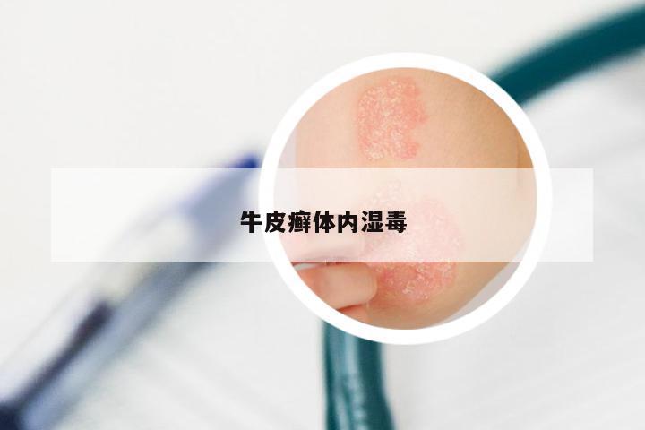 牛皮癣体内湿毒