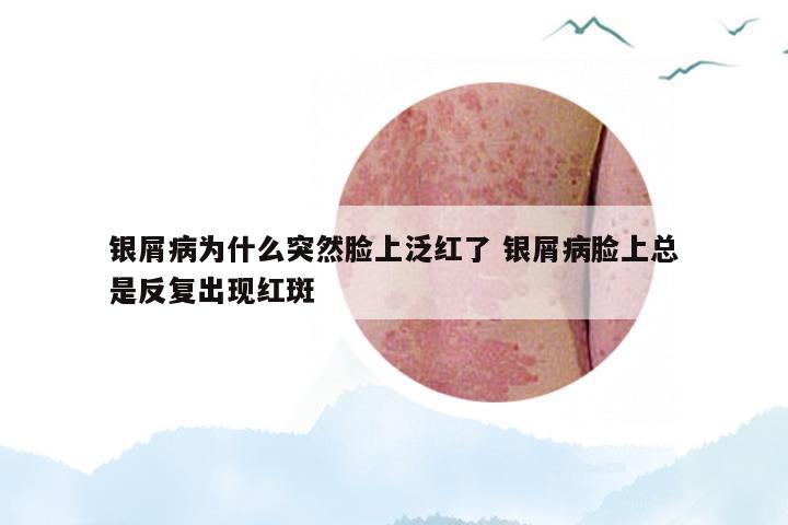 银屑病为什么突然脸上泛红了 银屑病脸上总是反复出现红斑