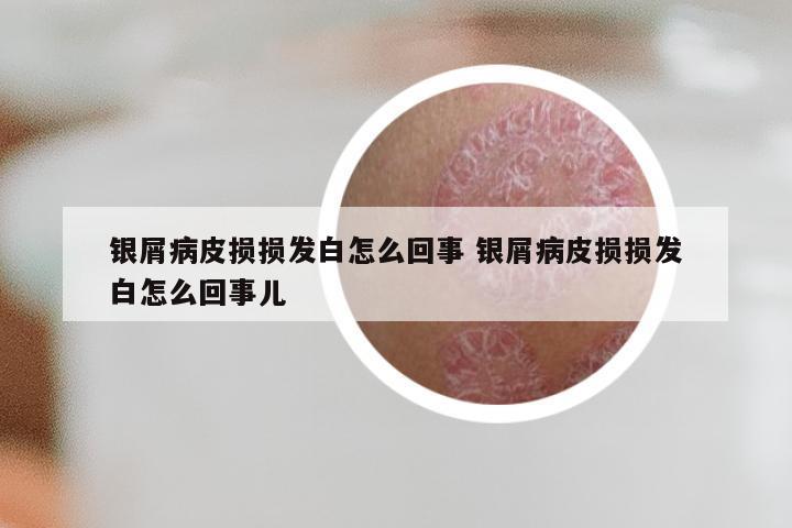 银屑病皮损损发白怎么回事 银屑病皮损损发白怎么回事儿