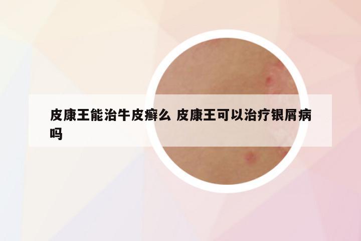 皮康王能治牛皮癣么 皮康王可以治疗银屑病吗