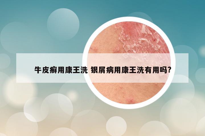 牛皮癣用康王洗 银屑病用康王洗有用吗?