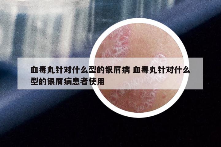 血毒丸针对什么型的银屑病 血毒丸针对什么型的银屑病患者使用