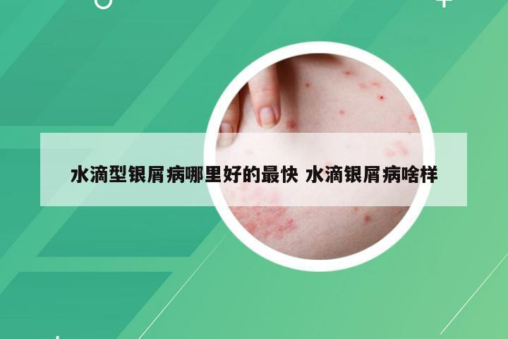 水滴型银屑病哪里好的最快 水滴银屑病啥样