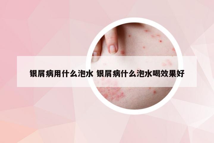 银屑病用什么泡水 银屑病什么泡水喝效果好