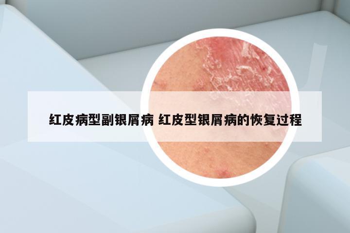 红皮病型副银屑病 红皮型银屑病的恢复过程