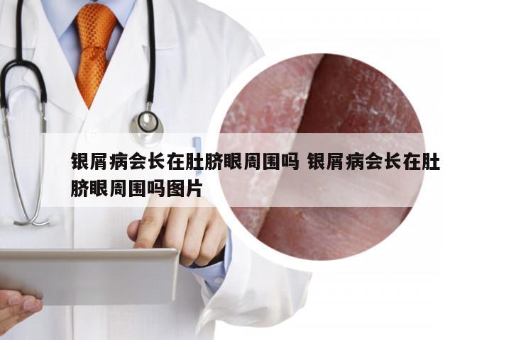 银屑病会长在肚脐眼周围吗 银屑病会长在肚脐眼周围吗图片
