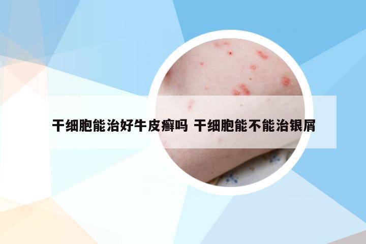 干细胞能治好牛皮癣吗 干细胞能不能治银屑
