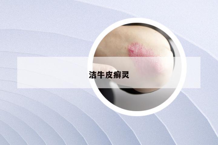 洁牛皮癣灵