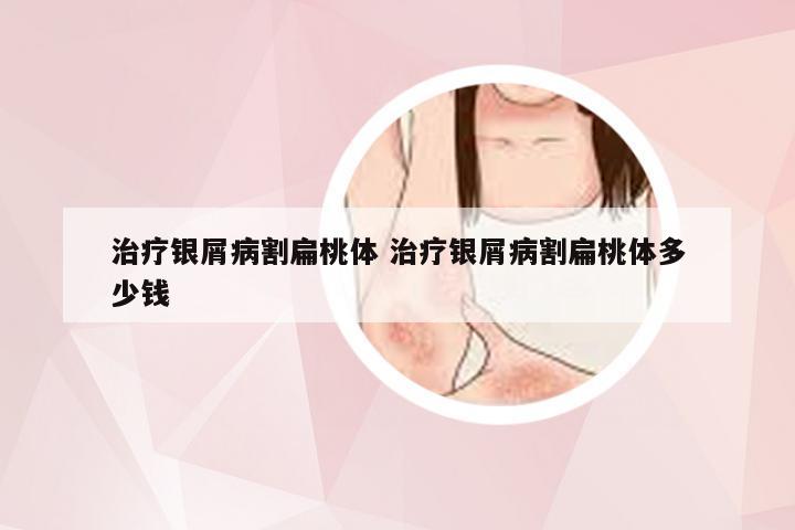 治疗银屑病割扁桃体 治疗银屑病割扁桃体多少钱