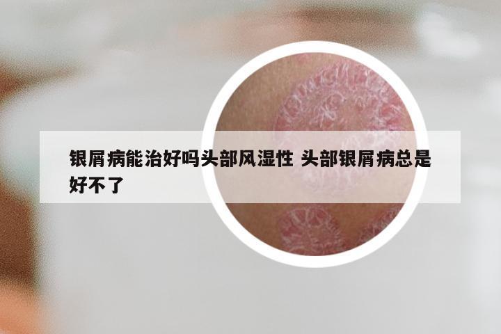 银屑病能治好吗头部风湿性 头部银屑病总是好不了