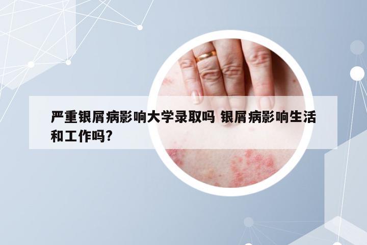严重银屑病影响大学录取吗 银屑病影响生活和工作吗?